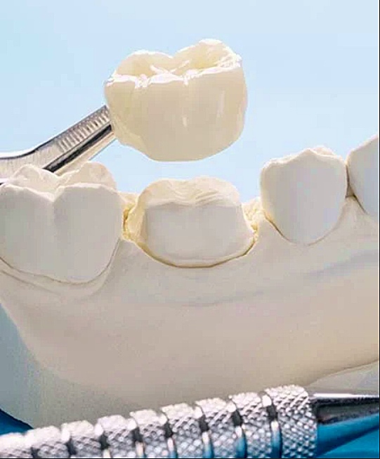 Металокераміка, незнімні зубні протези